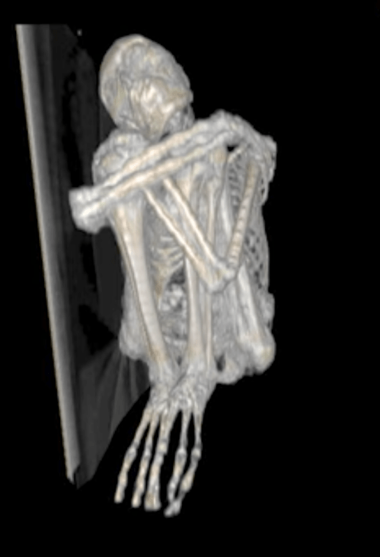 Picture: CAT Scan of the Three-fingered Body