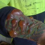 Picture about Tattoo Caused Infections