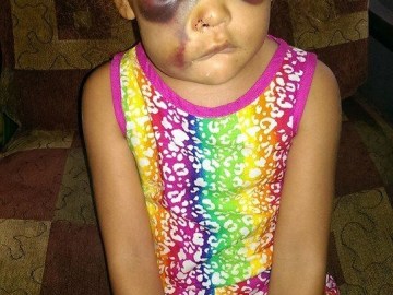 Picture about Badly Beaten in School, Justice for AvaLynn