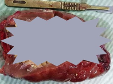 Disturbing Picture of Coke Causing Kidney Full of Stones