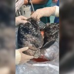Image from Shocking Video of Lungs Blackened After Decades of Smoking
