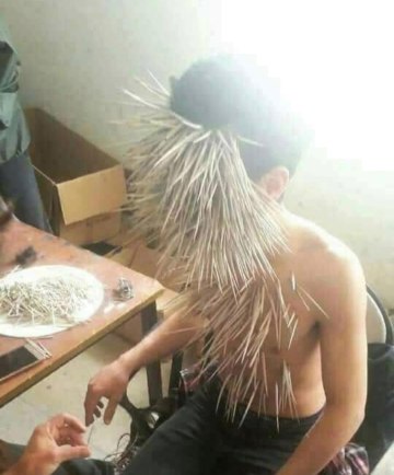 Image about Photograph Showing Aftermath of a Porcupine Selfie